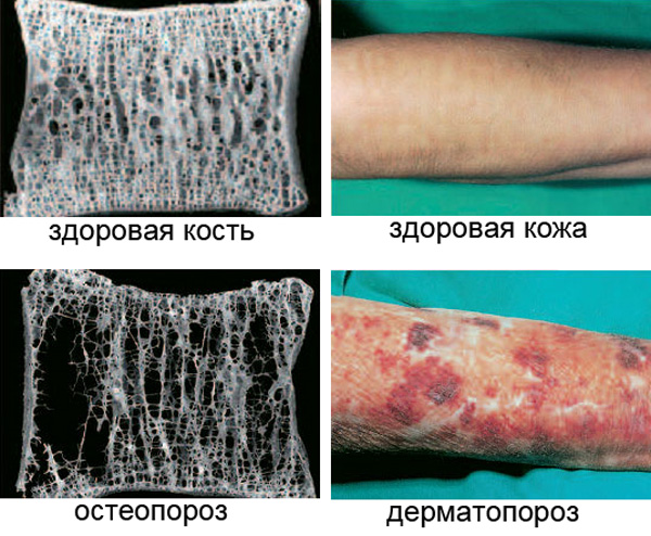 dermatoporosis