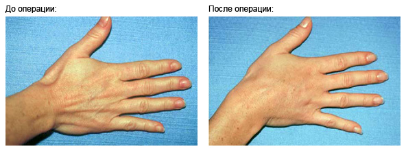 lipofiling-hand
