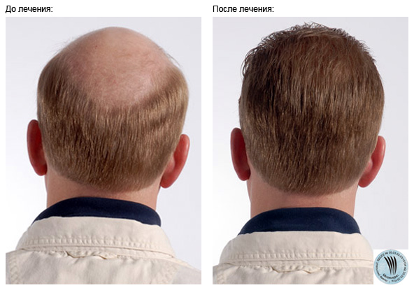 alopecia-men