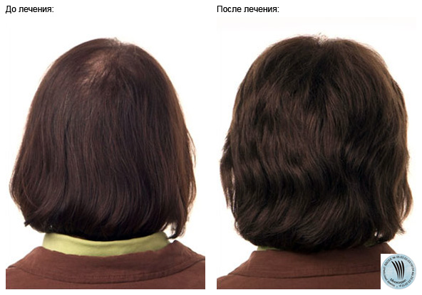 alopecia-women