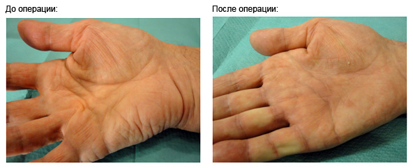 dupuytrens-contracture