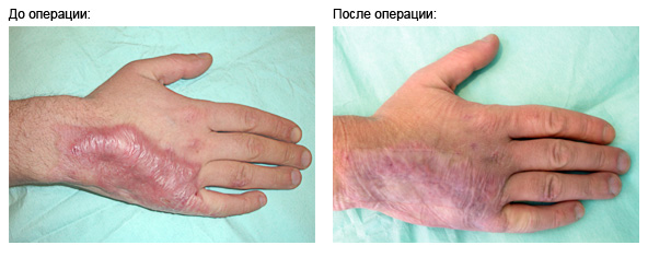 lipofiling-hand-scar