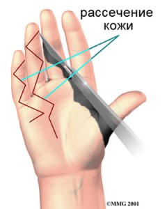 hand_dupuytrens_surgery01