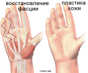 hand_dupuytrens_surgery03