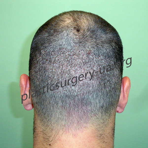 на-5-й-день-затылок1