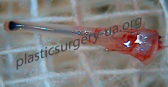 графт-1-волос1