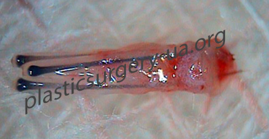 графт-3-фолоса1