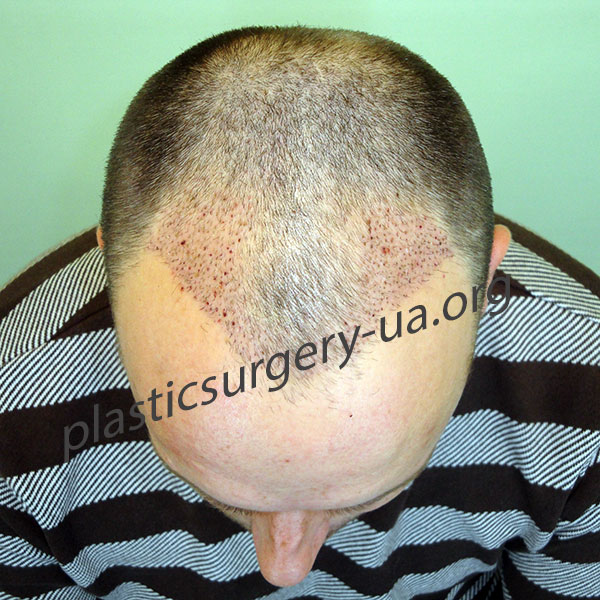 5-й день после процедуры