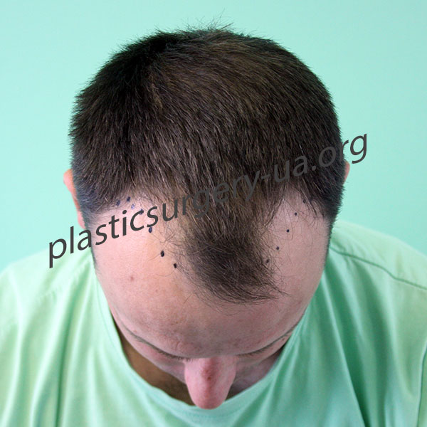 Шаг1. Проведение разметки и подготовка к процедуре