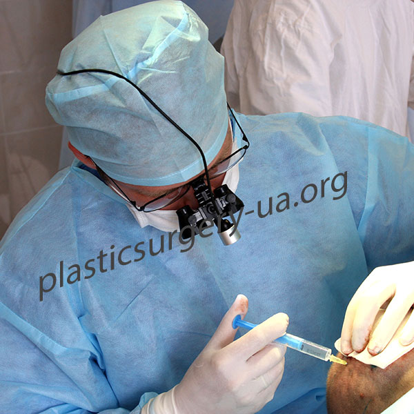 Шаг2. Обработка операционного поля антисептиком. Введение анестетика в донорскую область