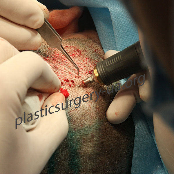 Шаг 3. Проведение микроразрезов при помощи специализированного оборудования и изымание графтов