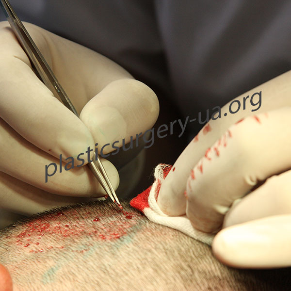 Шаг 3. Проведение микроразрезов при помощи специализированного оборудования и изымание графтов