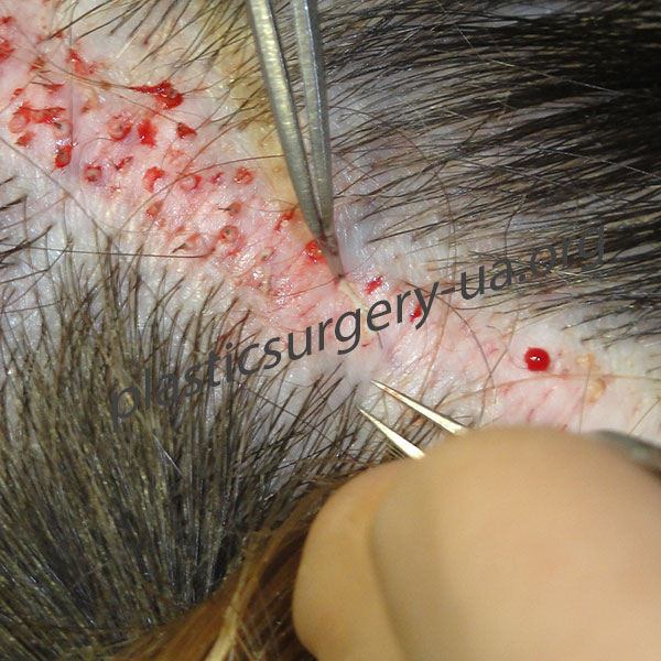 Шаг 6 . Нанесение микроразрезов и имплантация графтов в них