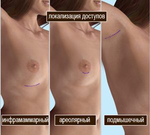 Рубцы после операции